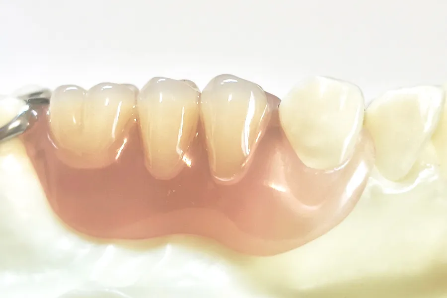 ノンクラスプデンチャー