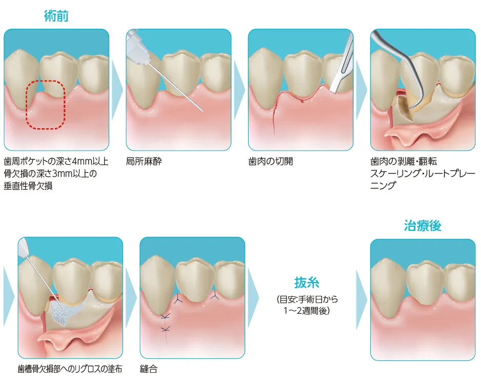リグロス投与方法